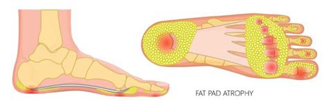 Bruised Heel (Fat Pad Contusion) Symptoms, Treatment Taping | vlr.eng.br