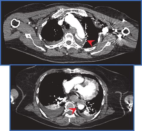 Trauma Pan Scan Computed Tomography Chest Revealed A Traumatic Aortic