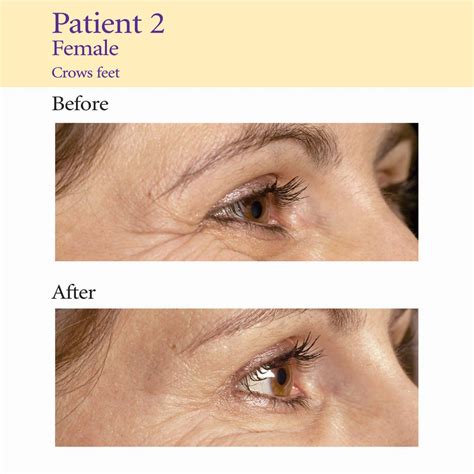 Anti Wrinkle Injections AESTHETIC MEDICINE