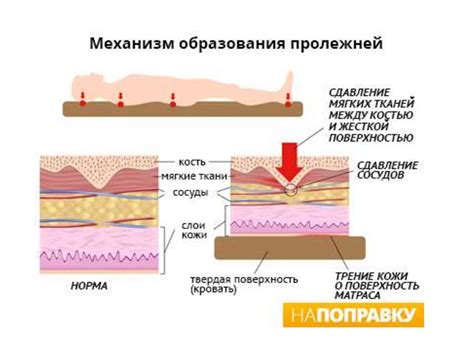 Профилактика пролежней - презентация онлайн