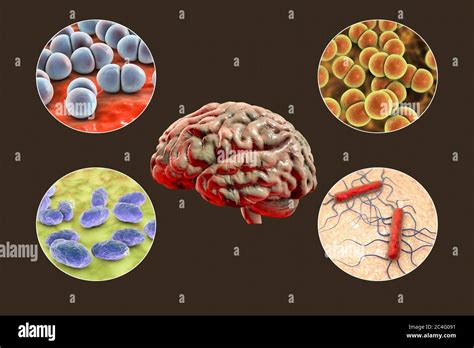 Causes De La Méningite Bactérienne Banque De Photographies Et Dimages à Haute Résolution Alamy