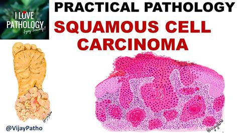 Squamous Cell Carcinoma Clinical Features And Morphology Premalignant Lesions Youtube