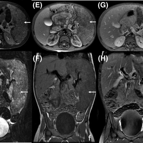 Ct And Mri Findings Of Splenomegaly Axial A And Coronal B Contrast