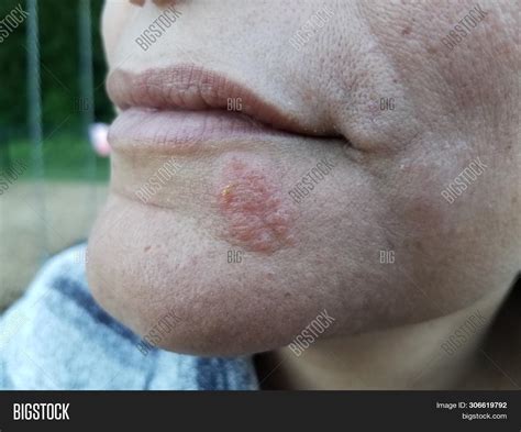 Red Rash Blister On Image And Photo Free Trial Bigstock