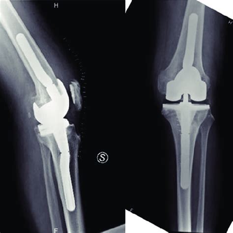 Pdf Condylar Constrained System In Primary Total Knee Replacement