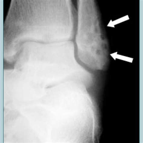 Plane X-ray showing osteolytic lesions on the left lateral malleolus ...