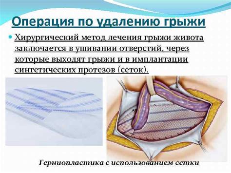 Грыжи живота Грыжи брюшной стенки (абдоминальные