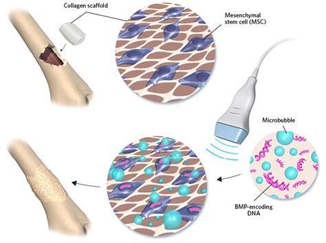 Infographic Ultrasound Stimulated Microbubbles Fix Fractures The