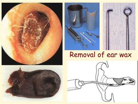 Ppt Otoscopy By Professor Dr Hassan Wahba Ear Nose And Throat Department Faculty Of Medicine