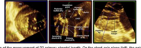 Figure From Visualization And Measurement Of Mitral Valve Chordae