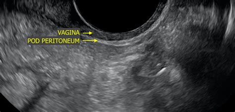 A Pictorial Guide To The Ultrasound Identification And Assessment Of