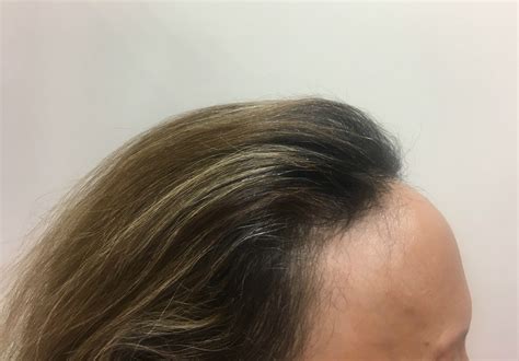 Granero Polvoriento Pisoteando Alopecia Frontal Fibrosante Cejas Sabio