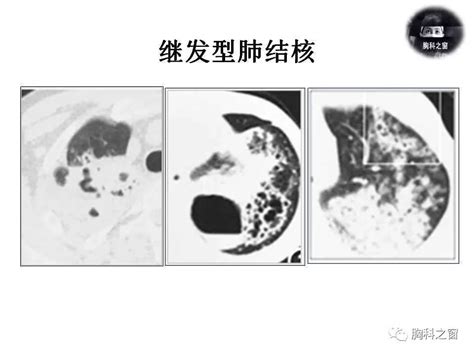 金黄色葡萄球菌肺炎的影像学表现气囊