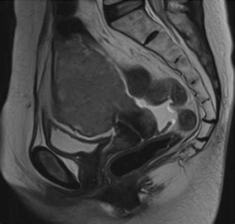 Sagittal T2 Fse Demonstrates The T2 Intermediate Uterine Mass With