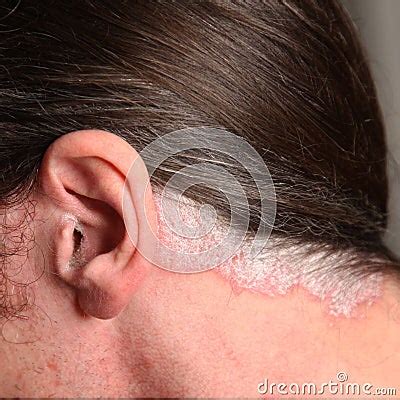 Psoriasis In The Ear And Neck Royalty Free Stock Photo - Image: 17539215