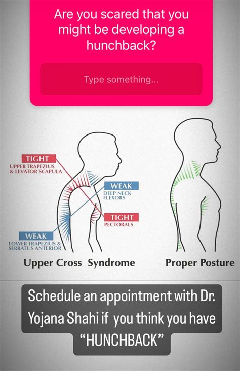 CHIROPRACTIC TREATMENT FOR UPPER CROSSED SYNDROME: UPPER CROSSED ... 