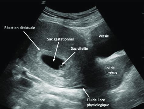 Sac Vitellin Visible Dans Le Sac Gestationnel Entour De La R Action