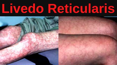 What Is Livedo Reticularis Causes Treatment YouTube