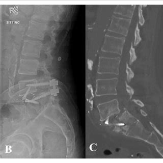 Patient Preoperative Lateral Radiograph Demonstrating Lytic Grade I