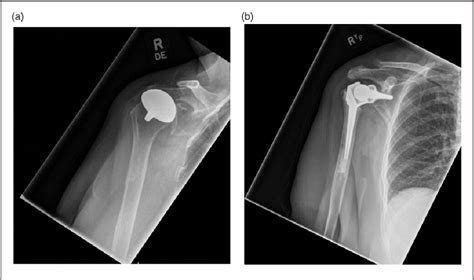 Revision shoulder arthroplasty for failed humeral head resurfacing ...