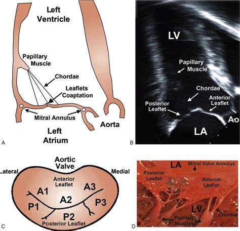 Mitral Valve Disease | Thoracic Key