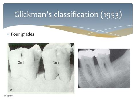 Furcation Involvement