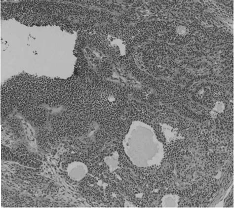 Figure 10 From Proliferative Lesions Of Ovarian Granulosa Cells And