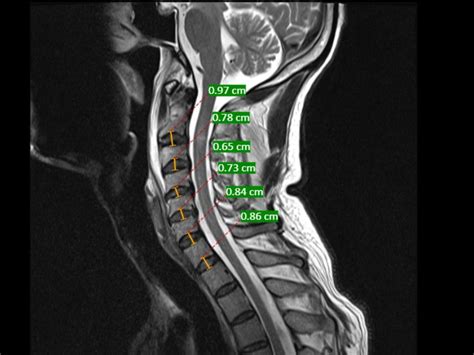 Ligamentum Flavum Cervical Spine