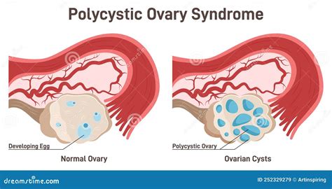 Polycystic Ovary Syndrome PCOS Hormonal Disease Stock Vector