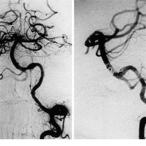 Preoperative Left Vertebral Angiograms Anteroposterior Left And