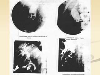 Estudio radiológico de la vesícula biliar PPT