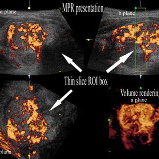 Three Dimensional Power Doppler Ultrasound Of Papillary Cancer With Low