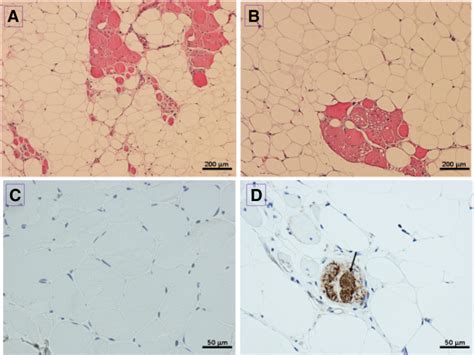 A Novel Missense Mutation In The MYH7 Gene Causes An Uncharacteristic