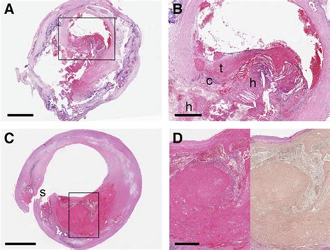 Sex Is Associated With The Presence Of Atherosclerotic Plaque