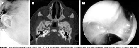 Choanal Atresia | Semantic Scholar
