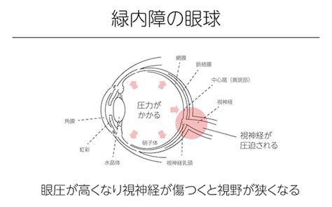 Ilustración Glaucoma Del Ojo Ilustraciones Médicas Vector Premium