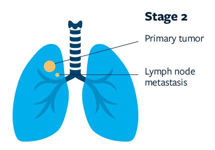 Stage 2 Of Lung Cancer