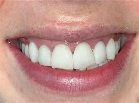 Case 6 Smile Makeovers Before And After Gallery