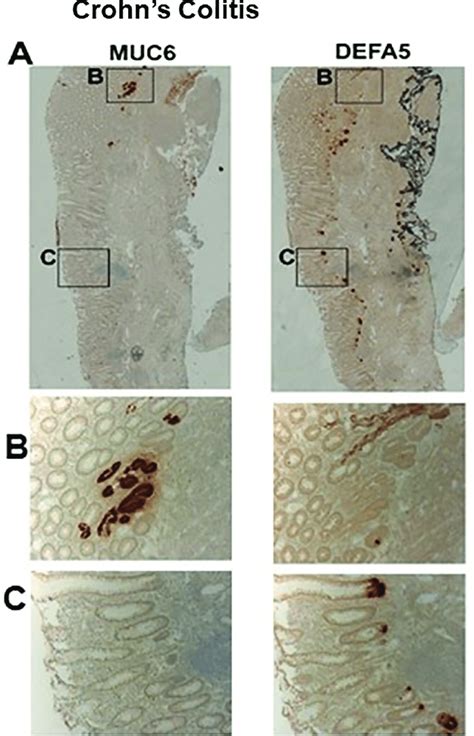 Immunohistochemical Detection Of CCLCs Marker Positive For Paneth