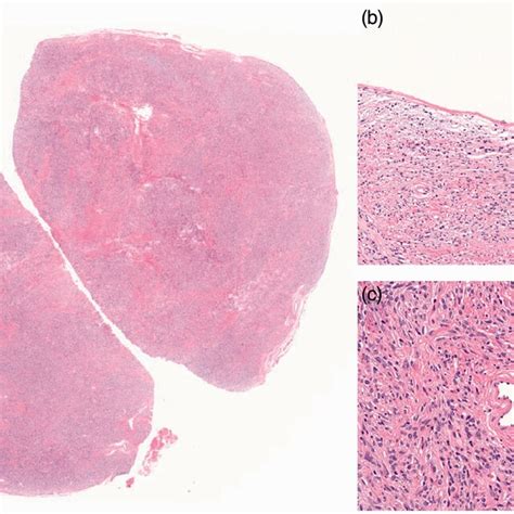 Microscopic Findings Of The Cellular Solitary Fibrous Tumor A The