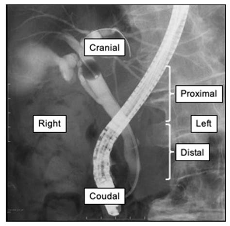 Cholecystitis X Ray