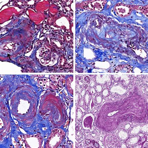 Glomerulus With Capillary Thrombi A Capillary Thrombi Arrow