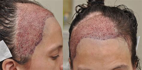 Brain Surgery Scar Hair