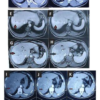 Years Old Male Patient With Cirrhotic Liver And Hcc Triphasic Ct