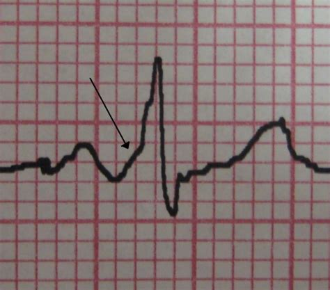 Wolffparkinsonwhite Syndrome Wikem