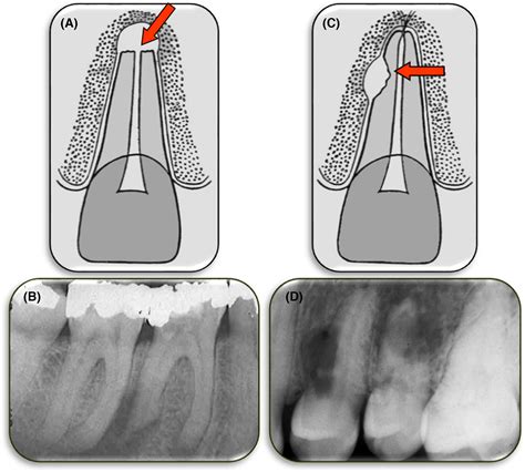 Tooth Resorptionpart A Clinical Classification Abbott