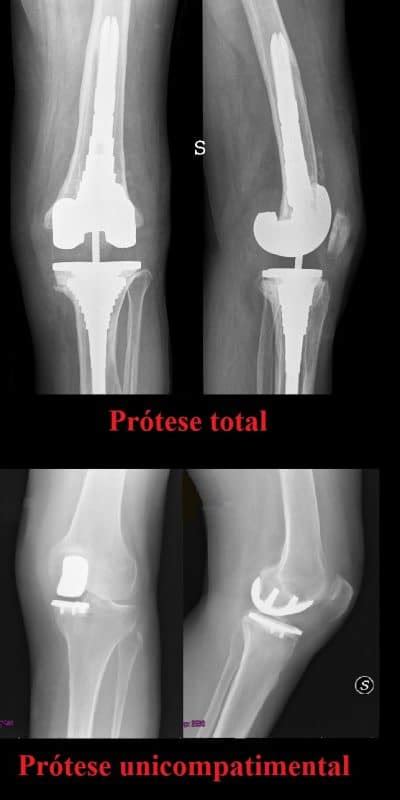 Pr Tese Do Joelho Cirurgia E Riscos Total Unicompartimental Material