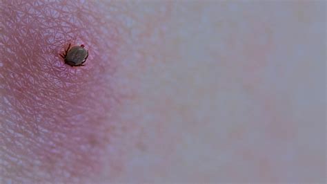 What Does a Tick Bite Look Like? (And How to Prevent Them) 