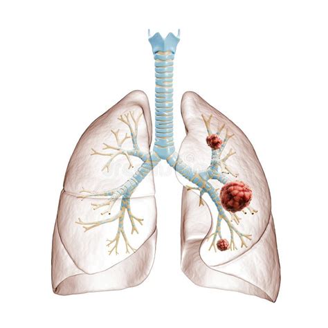 Lung Cancer Or Carcinoma D Rendering Illustration Bronchial Tree And