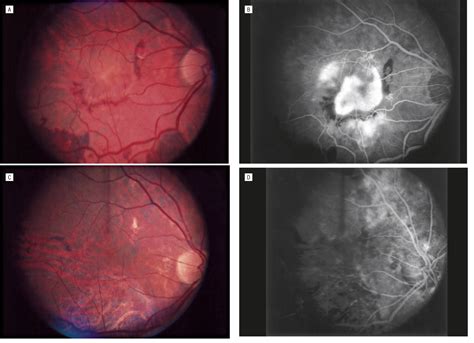 Visual Outcomes Following Macular Translocation With Peripheral